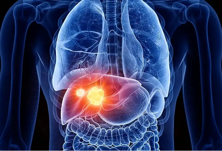 The Search for a Hidden Hero in Liver Cancer Treatment